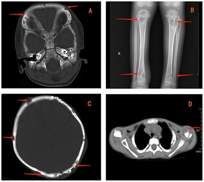 Case Report: Disseminated Mycobacterium intracellulare Infection With More Than 1-Year Follow-Up in a Young Boy With IFNGR1 Deficiency